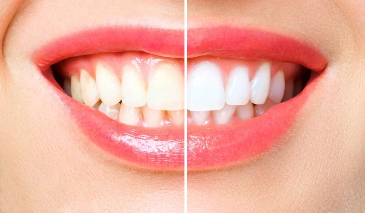 North Canton Cosmetic Dentist: Veneers & Whitening