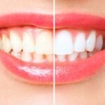 North Canton Cosmetic Dentist: Veneers & Whitening
