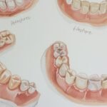 Dentures North Canton Restore Your Smile and Confidence