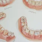 Dentures North Canton Restore Your Smile and Confidence