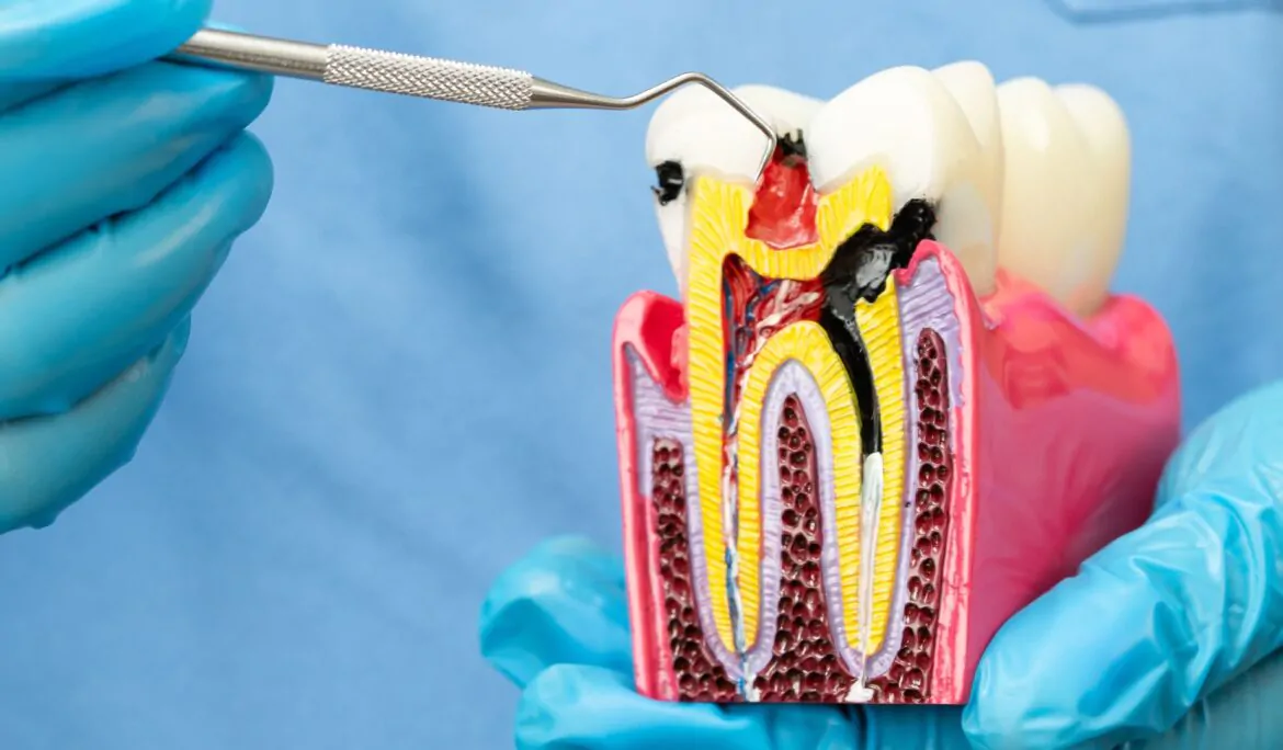 Root canal North Canton